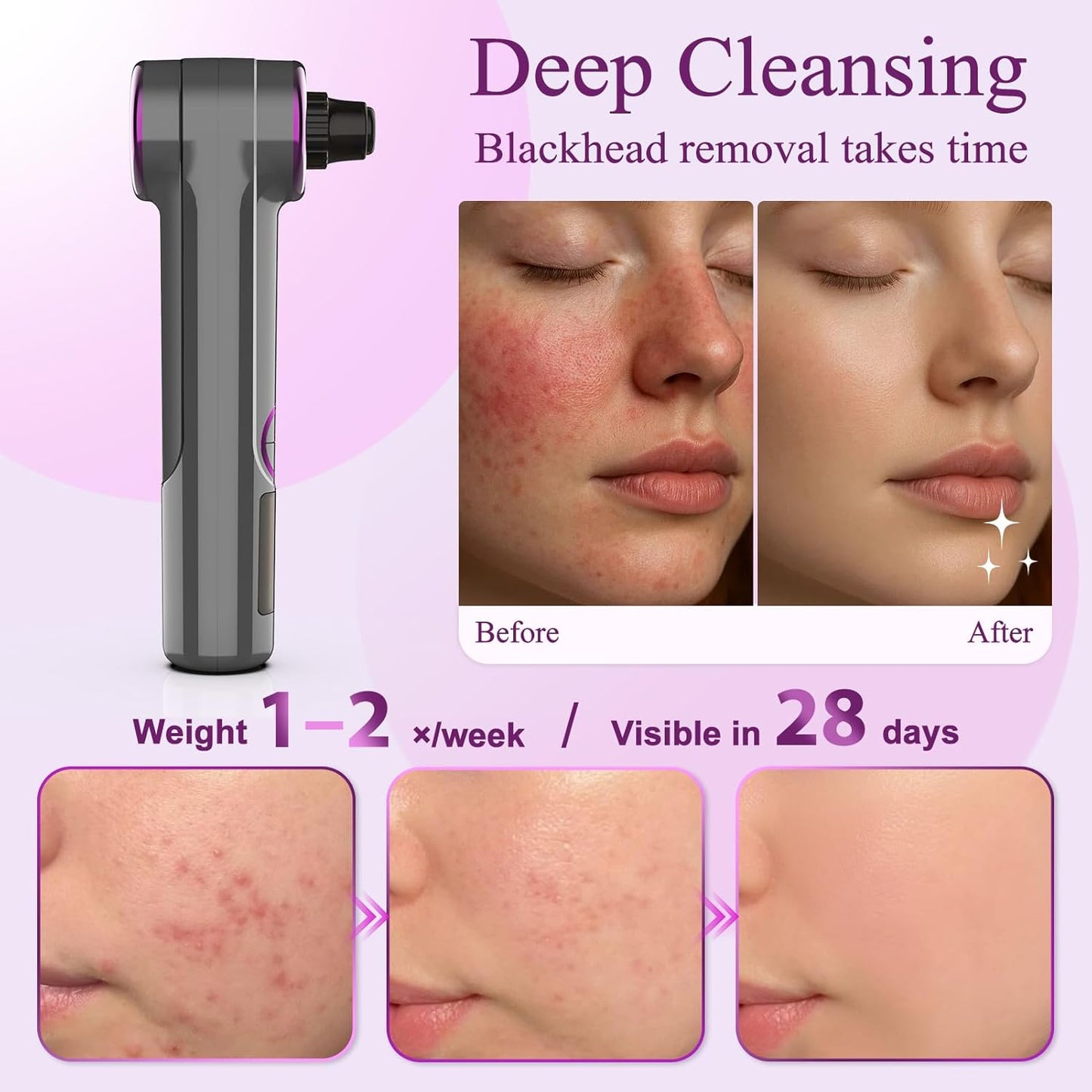 Blackhead Vacuum Removers with Heating, Pore Vacuum Blackhead Suction Remover, 3 Adjustable Suction Levels 9 Modes, Comedone Extractor Kit with 5 Suction Heads for Nose & Face Deep Pore Cleaning